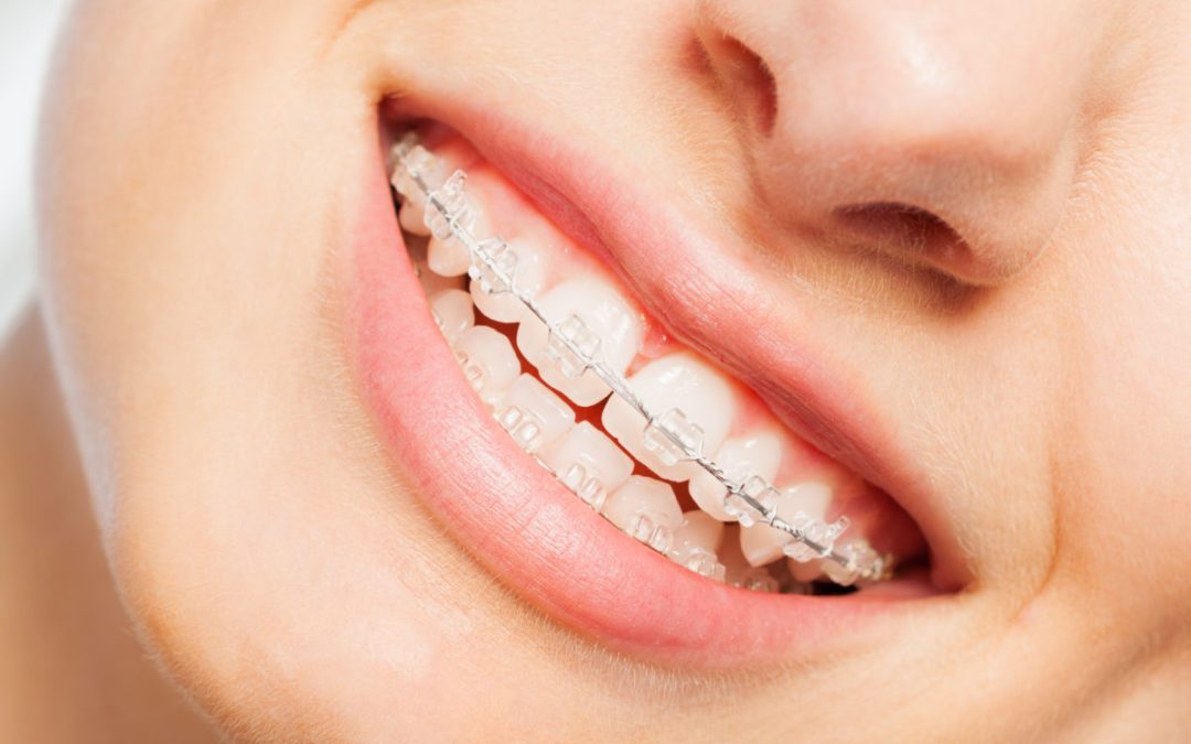 How Are Clear Braces Different from Metal Braces?