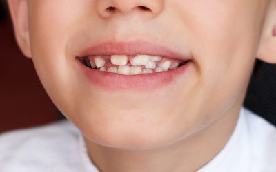 What Causes Crooked Teeth? How They’re Fixed