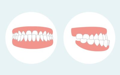 Understand Underbite: Causes & Treatment Options