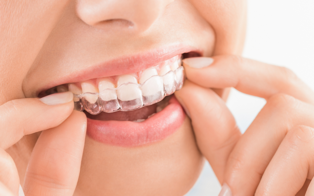 Protected: Invisalign & Clear Braces – Affordable Orthodontic Options With Flexible Payments